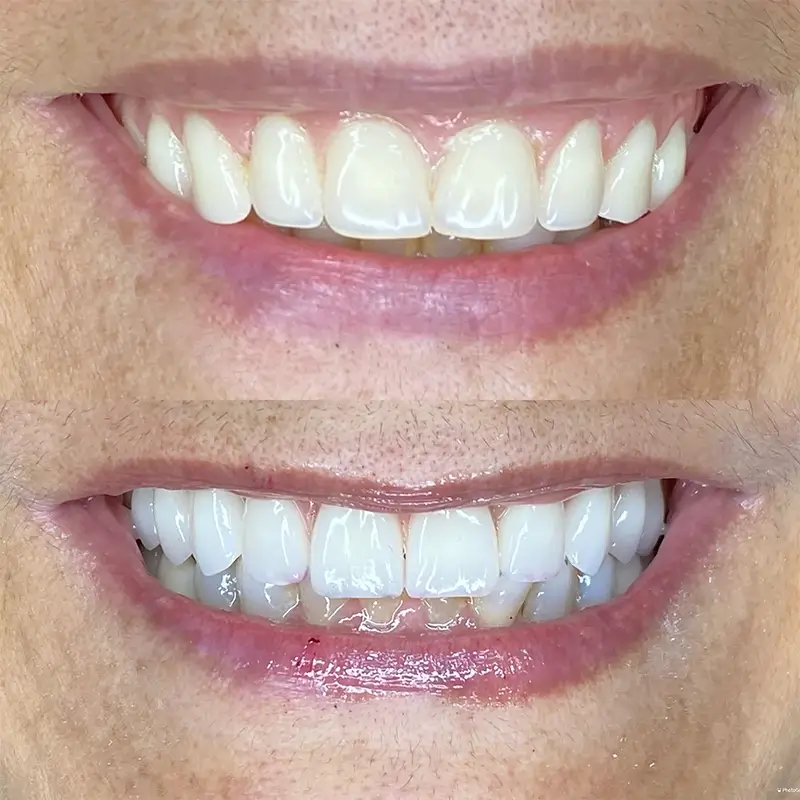 carrossel-antes-depois-2