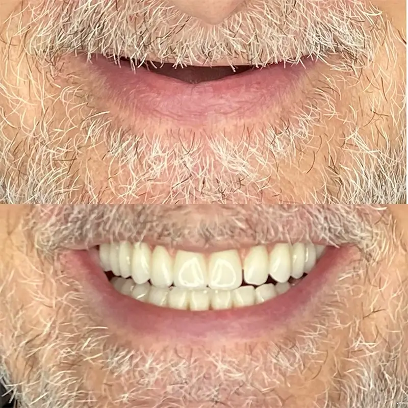 carrossel-antes-depois-5