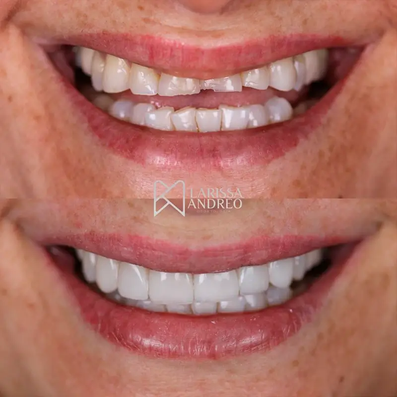 carrossel-facetas-resinas-1