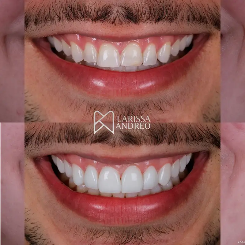 carrossel-facetas-resinas-3