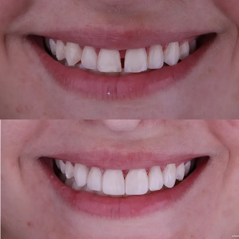 carrossel-facetas-resinas-4