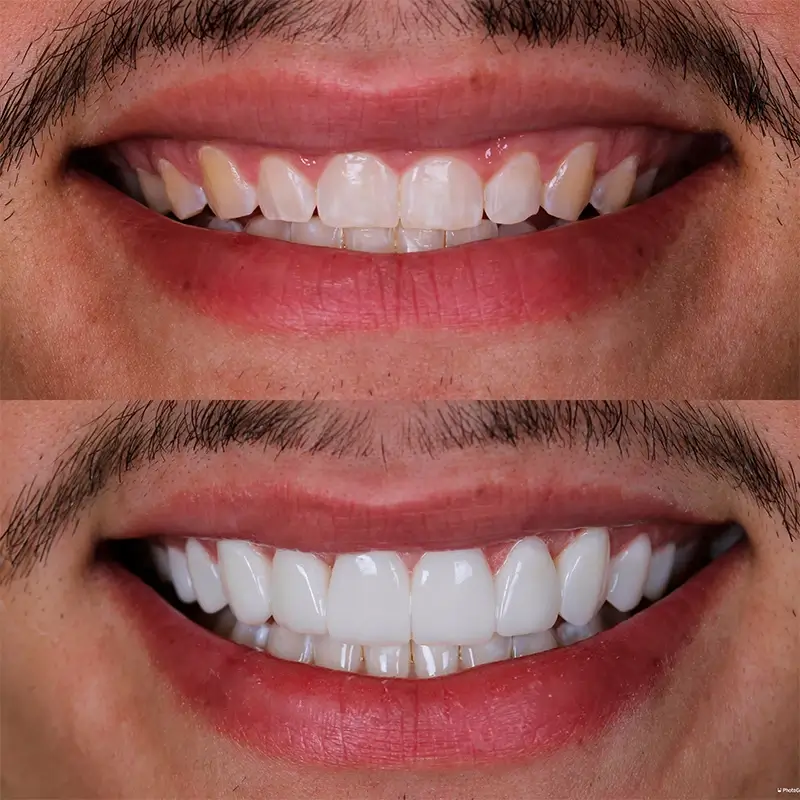 carrossel-facetas-resinas-5