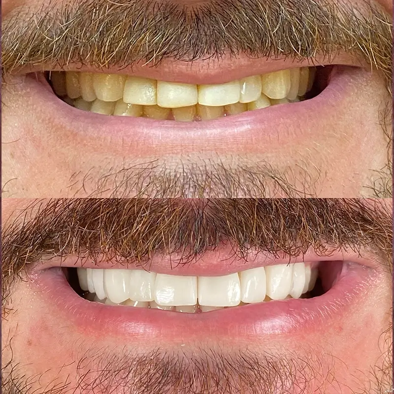 carrossel-lentes-porcelana-3