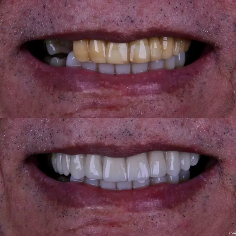 carrossel-lentes-porcelana-4