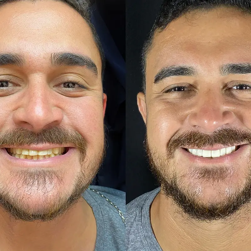 carrossel-lentes-porcelana-5