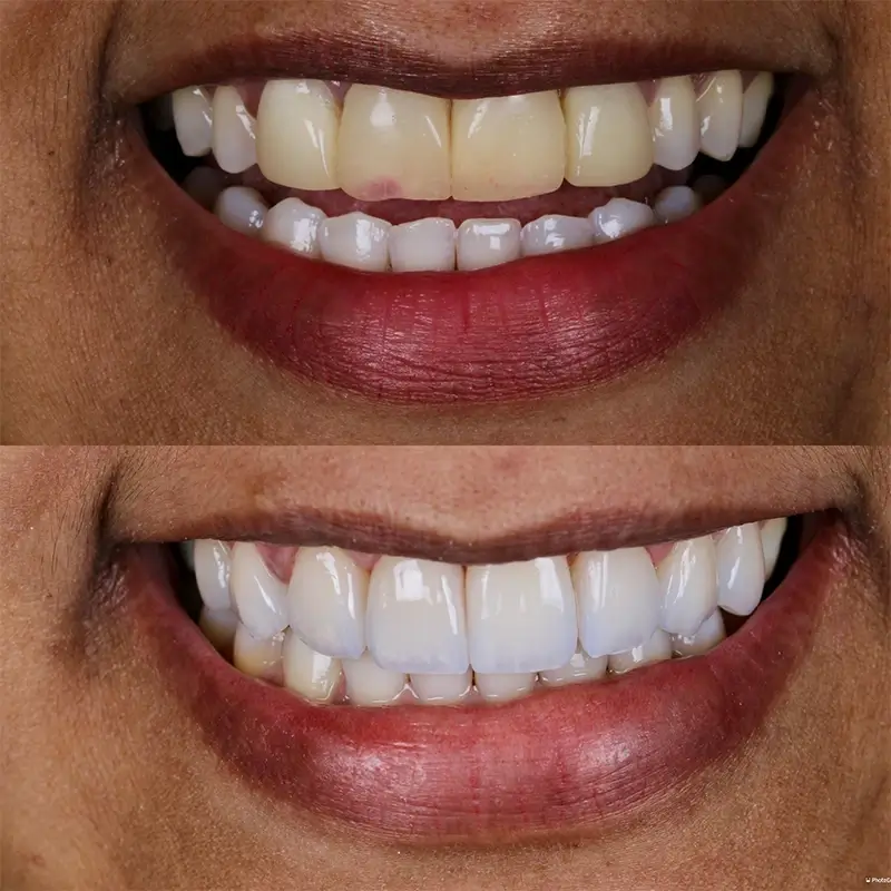 carrossel-lentes-porcelana-6