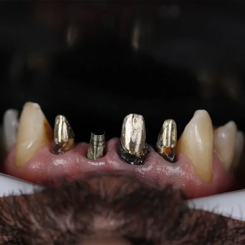 carrossel-proteses-fixas-1