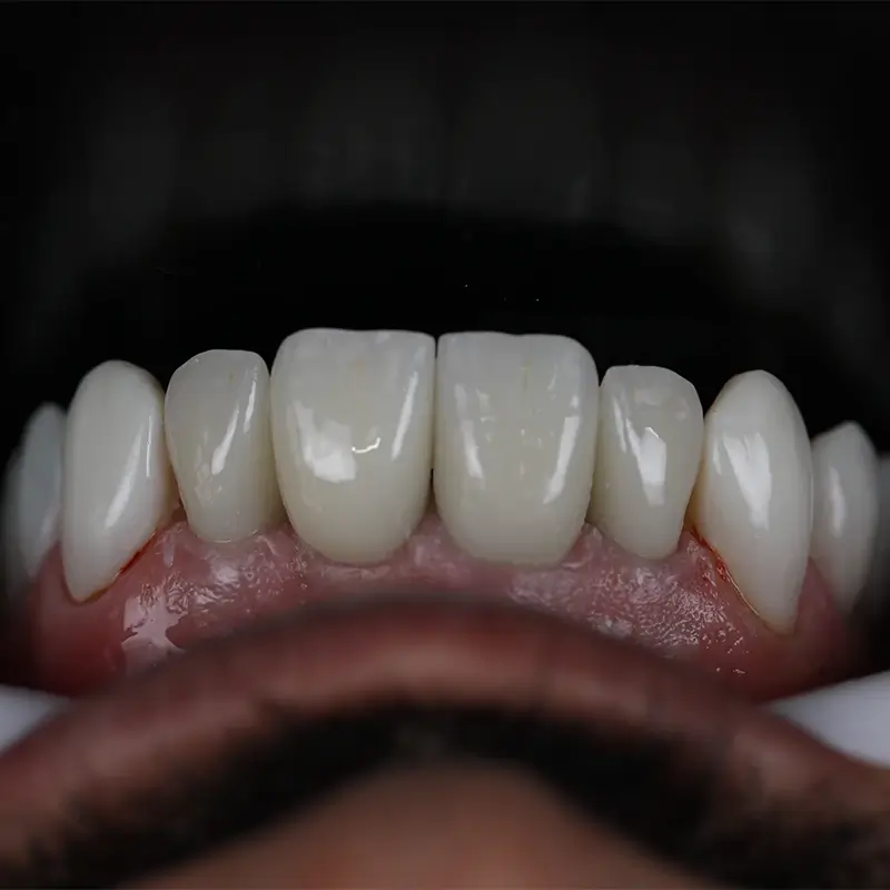 carrossel-proteses-fixas-2